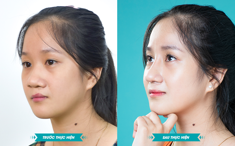 ảnh khách hàng phẫu thuật smhhe tại JK Nhật Hàn 6