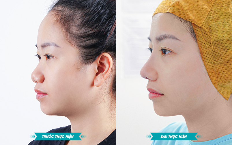 Ảnh khách hàng thẩm mỹ mũi tại JK Nhật Hàn 2
