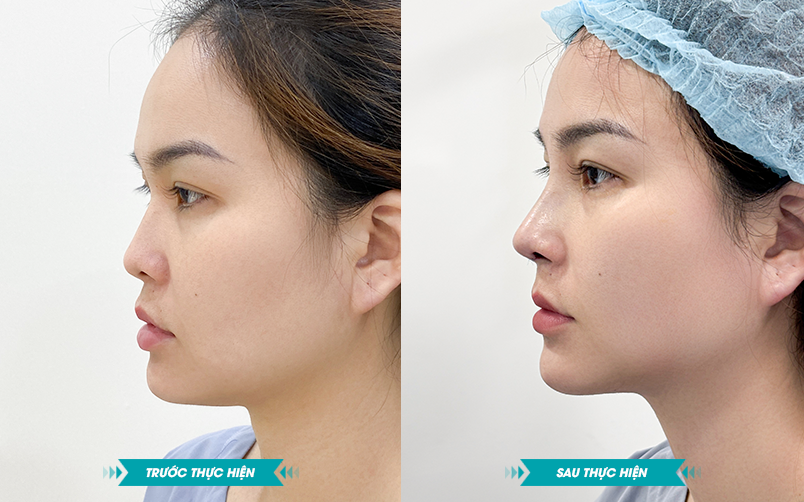 Ảnh khách hàng thẩm mỹ mũi tại JK Nhật Hàn 6