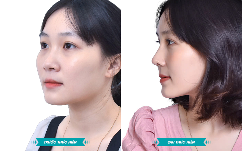 Ảnh khách hàng thẩm mỹ mũi tại JK Nhật Hàn 7