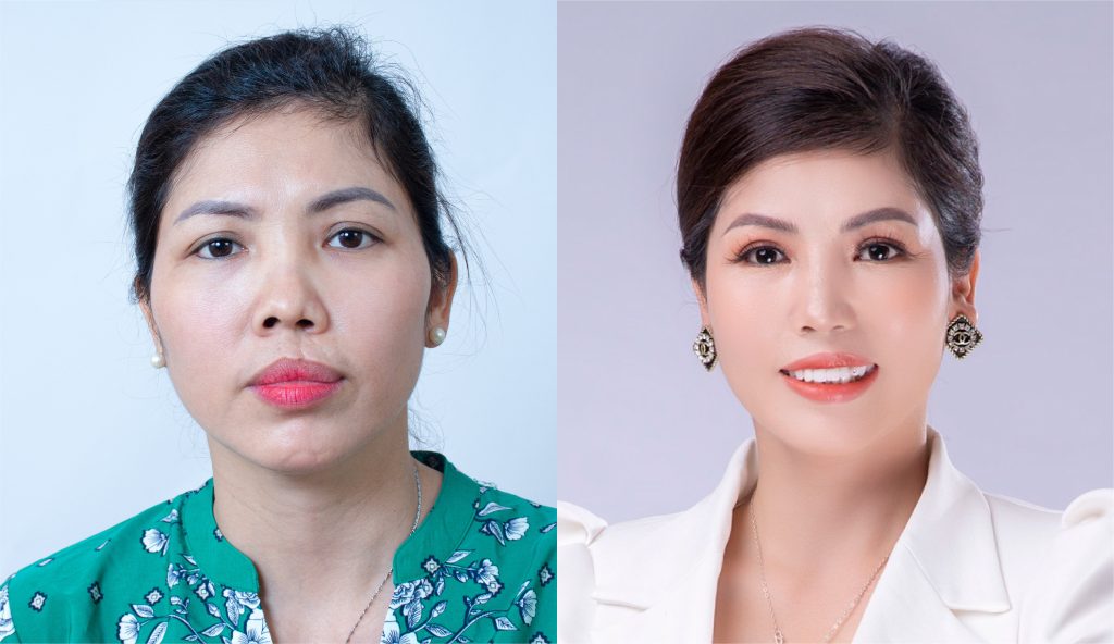 ảnh khách hàng phẫu thuật smhhe tại JK Nhật Hàn 8