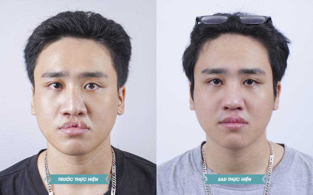 ảnh khách hàng phẫu thuật smhhe tại JK Nhật Hàn 9