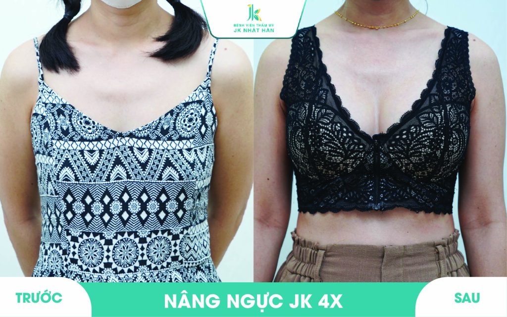 ảnh khách hàng phẫu thuật vòng 1 tại JK Nhật Hàn 2