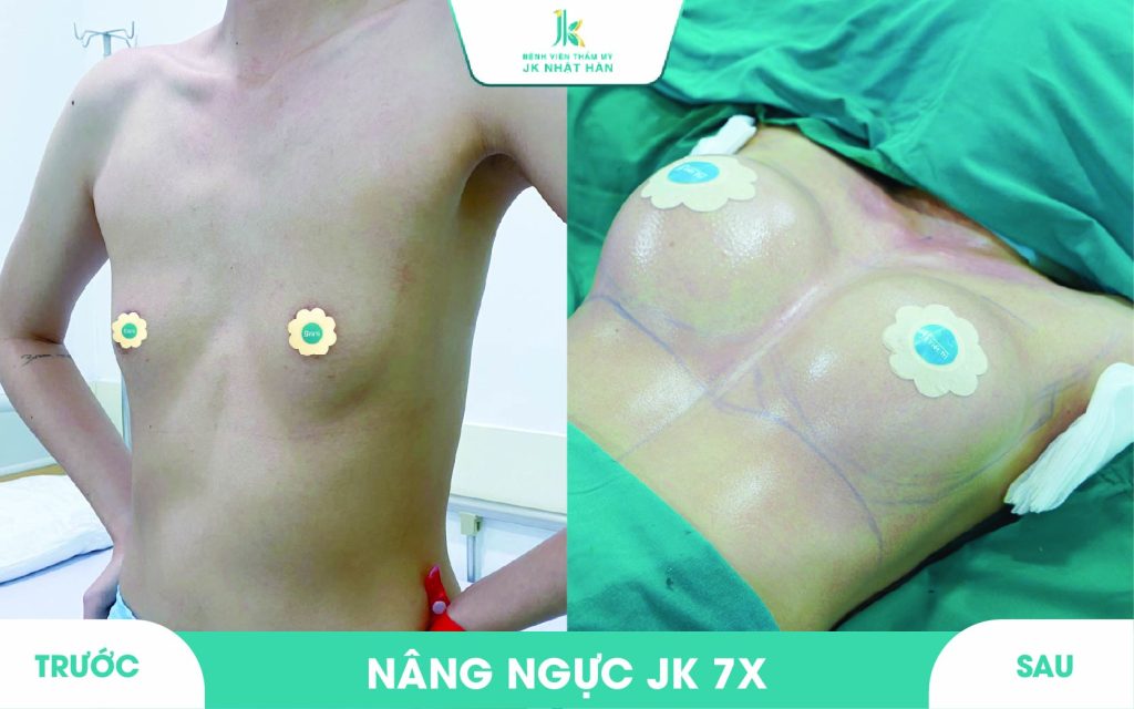 ảnh khách hàng phẫu thuật vòng 1 tại JK Nhật Hàn 3