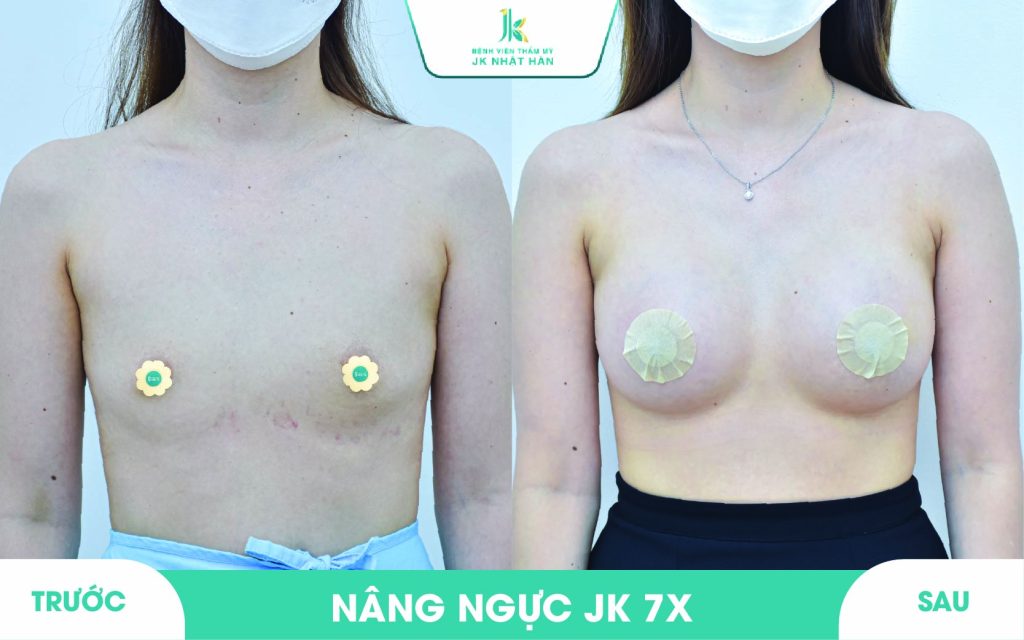 ảnh khách hàng phẫu thuật vòng 1 tại JK Nhật Hàn 4