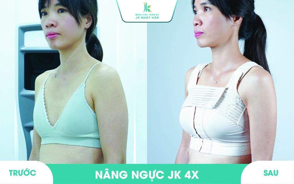 ảnh khách hàng phẫu thuật vòng 1 tại JK Nhật Hàn 5
