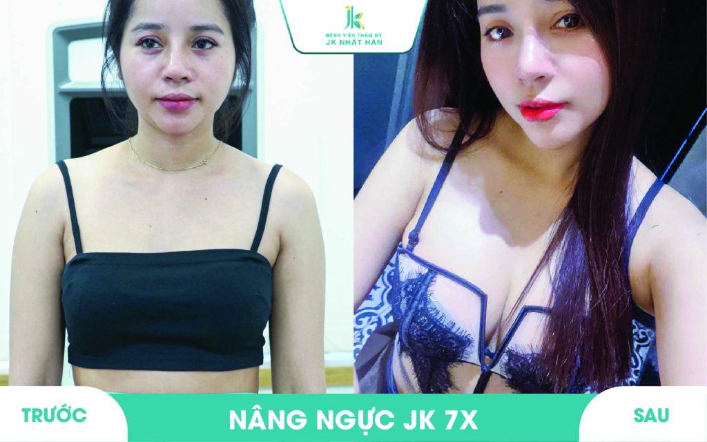 ảnh khách hàng thẩm mỹ vòng 1 tại JK Nhật Hàn 6