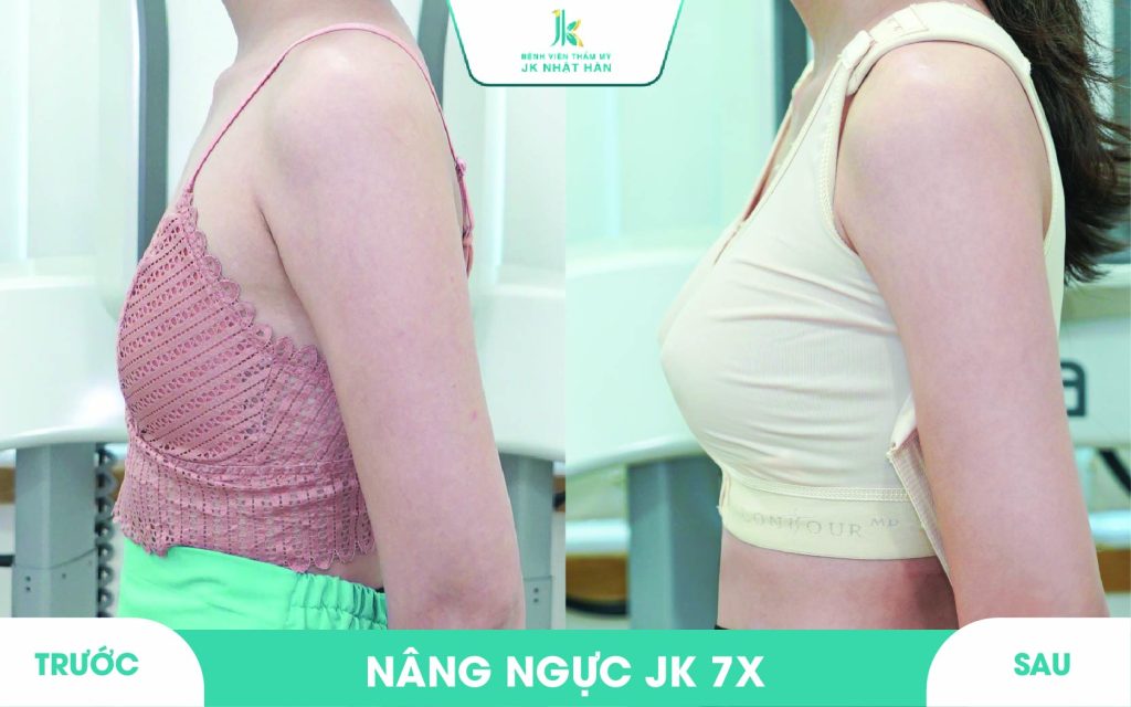 ảnh khách hàng thẩm mỹ vòng 1 tại JK Nhật Hàn 9