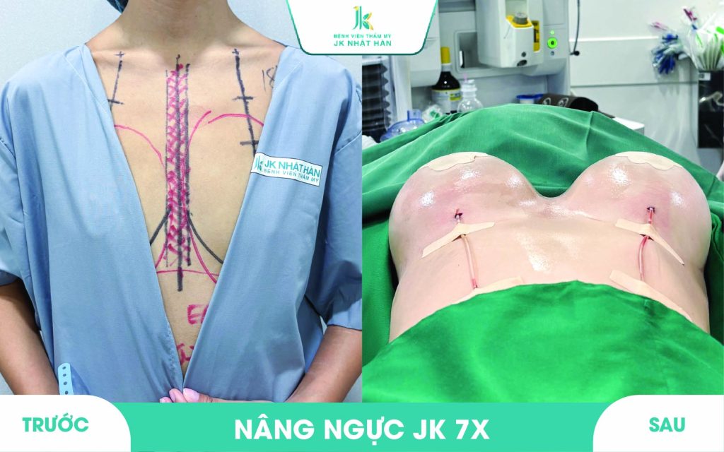 ảnh khách hàng thẩm mỹ vòng 1 tại JK Nhật Hàn 10