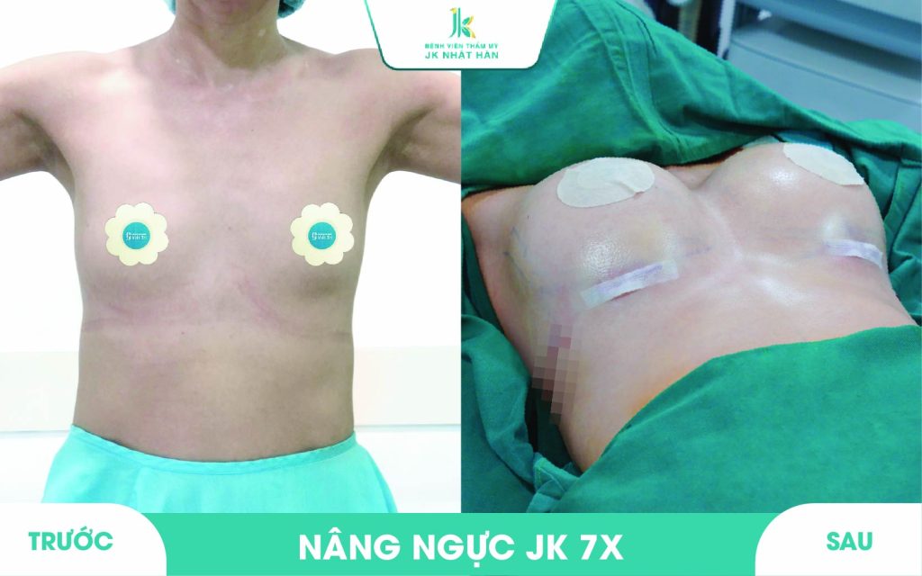 ảnh khách hàng thẩm mỹ vòng 1 tại JK Nhật Hàn 11