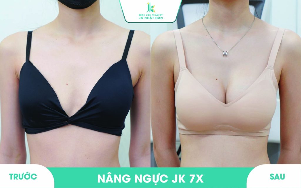 ảnh khách hàng thẩm mỹ vòng 1 tại JK Nhật Hàn 12