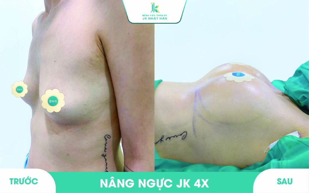 ảnh khách hàng thẩm mỹ vòng 1 tại JK Nhật Hàn 13