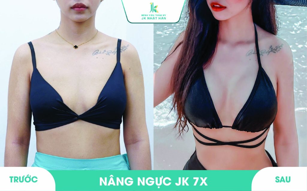 ảnh khách hàng thẩm mỹ vòng 1 tại JK Nhật Hàn 17