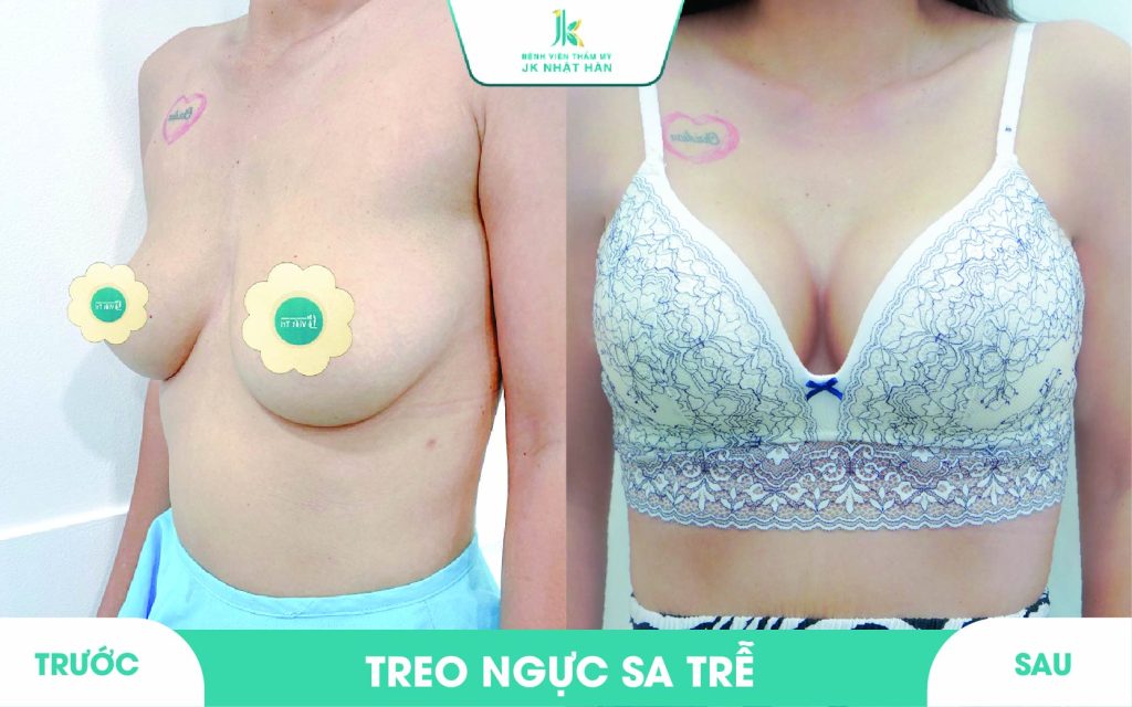 ảnh khách hàng thẩm mỹ vòng 1 tại JK Nhật Hàn 18