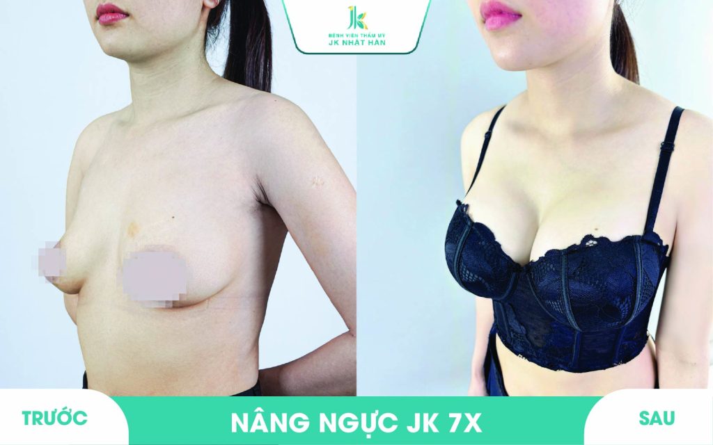 ảnh khách hàng thẩm mỹ vòng 1 tại JK Nhật Hàn 19