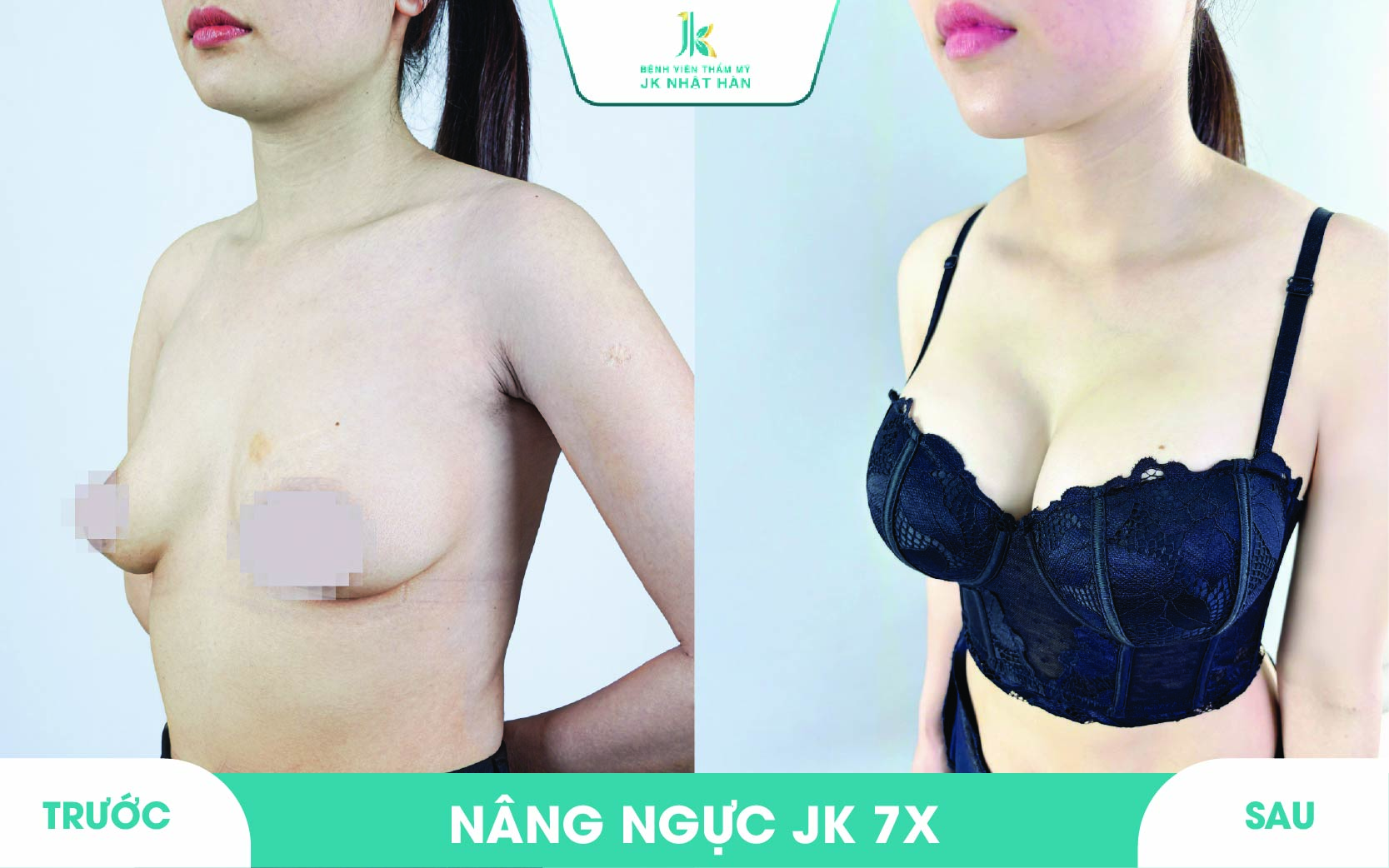 ảnh khách hàng thẩm mỹ vòng 1 tại JK Nhật Hàn 19