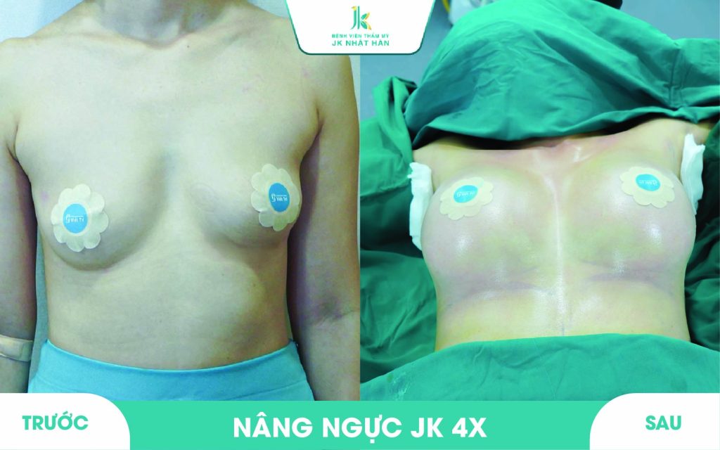 ảnh khách hàng thẩm mỹ vòng 1 tại JK Nhật Hàn 20