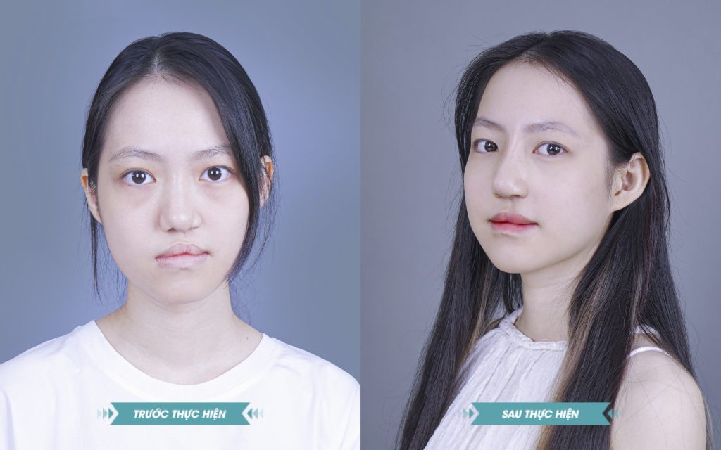 ảnh khách hàng phẫu thuật smhhe tại JK Nhật Hàn 10