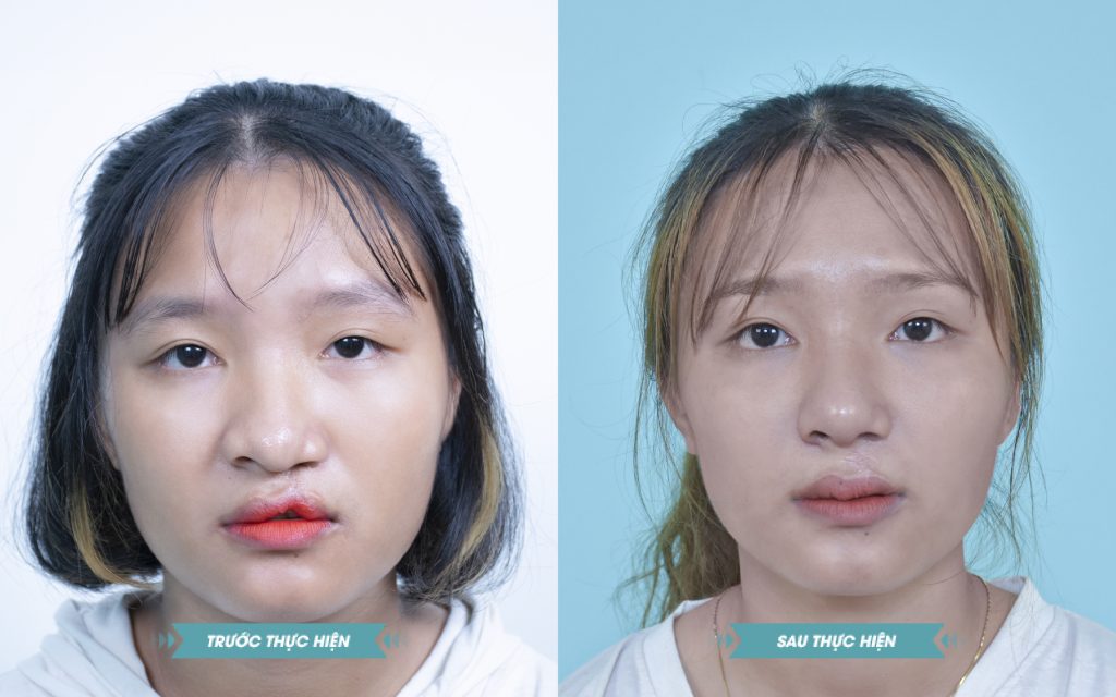 ảnh khách hàng phẫu thuật smhhe tại JK Nhật Hàn 11