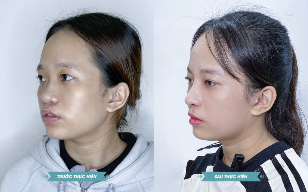 ảnh khách hàng phẫu thuật smhhe tại JK Nhật Hàn 12
