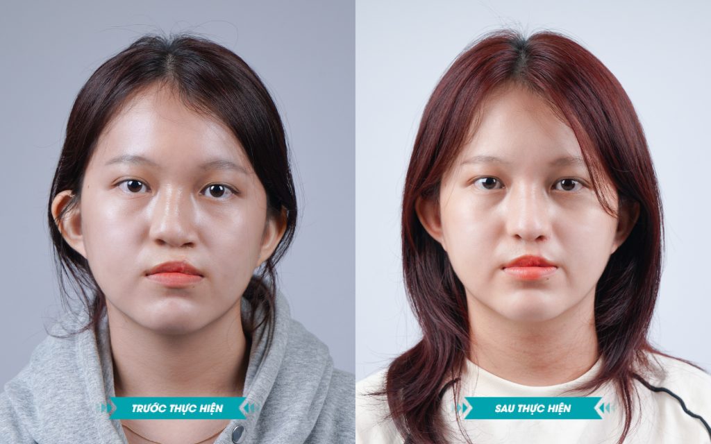 ảnh khách hàng phẫu thuật smhhe tại JK Nhật Hàn 15