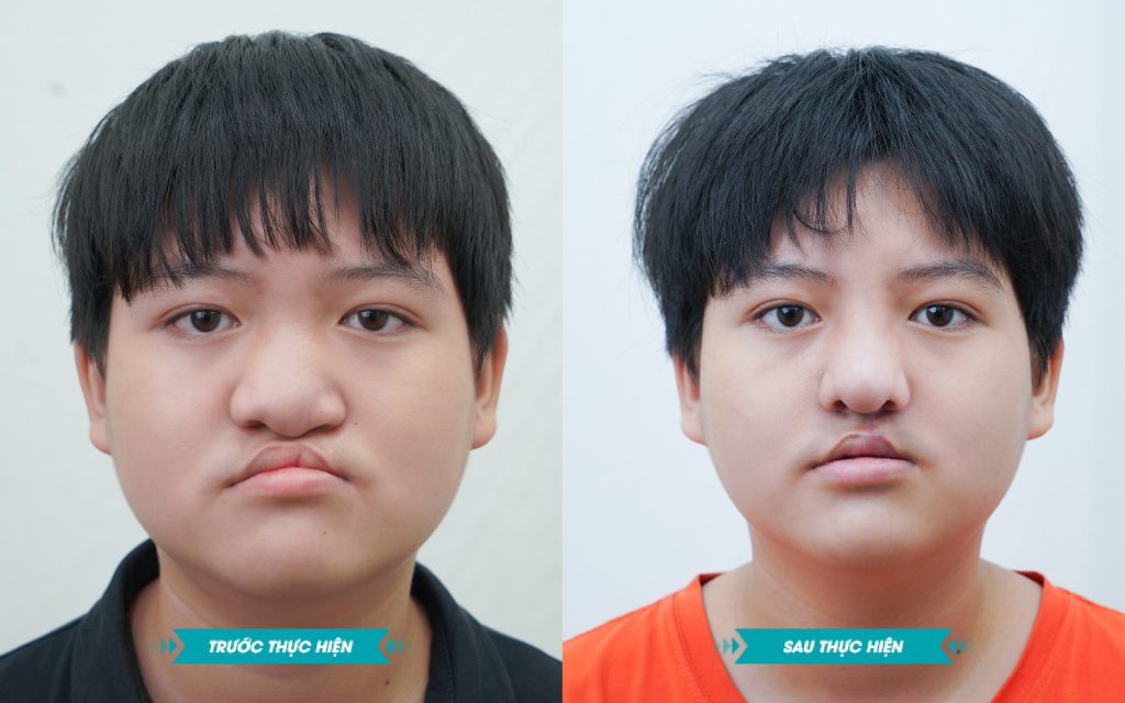 ảnh khách hàng phẫu thuật smhhe tại JK Nhật Hàn 16