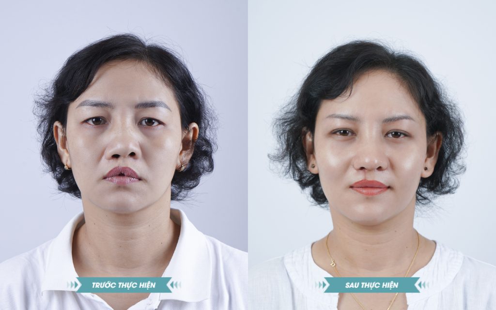 ảnh khách hàng phẫu thuật smhhe tại JK Nhật Hàn 13
