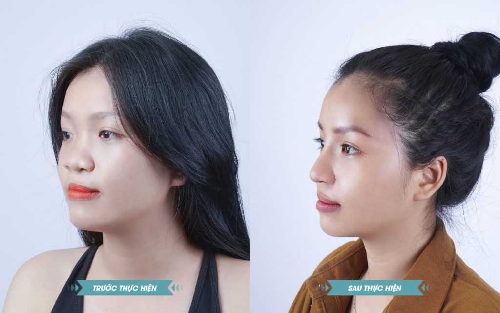 ảnh khách hàng phẫu thuật smhhe tại JK Nhật Hàn 13
