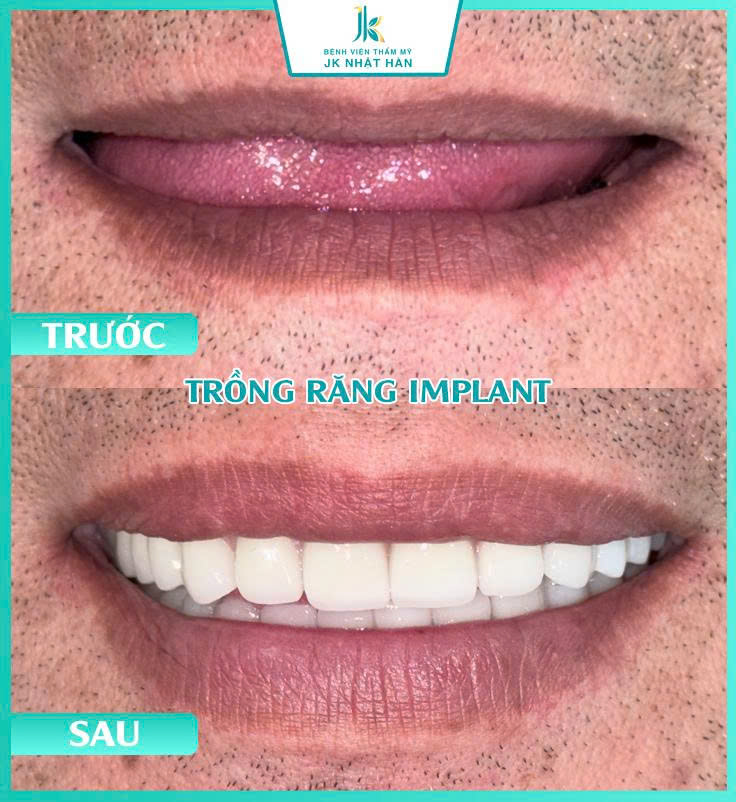ảnh khách hàng thẩm mỹ nha khoa 11