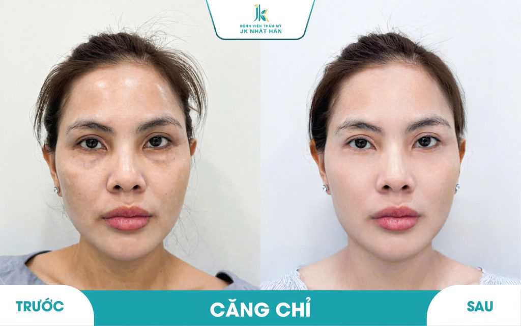 ảnh thực tế khách hàng thẩm mỹ không phẫu thuật 1