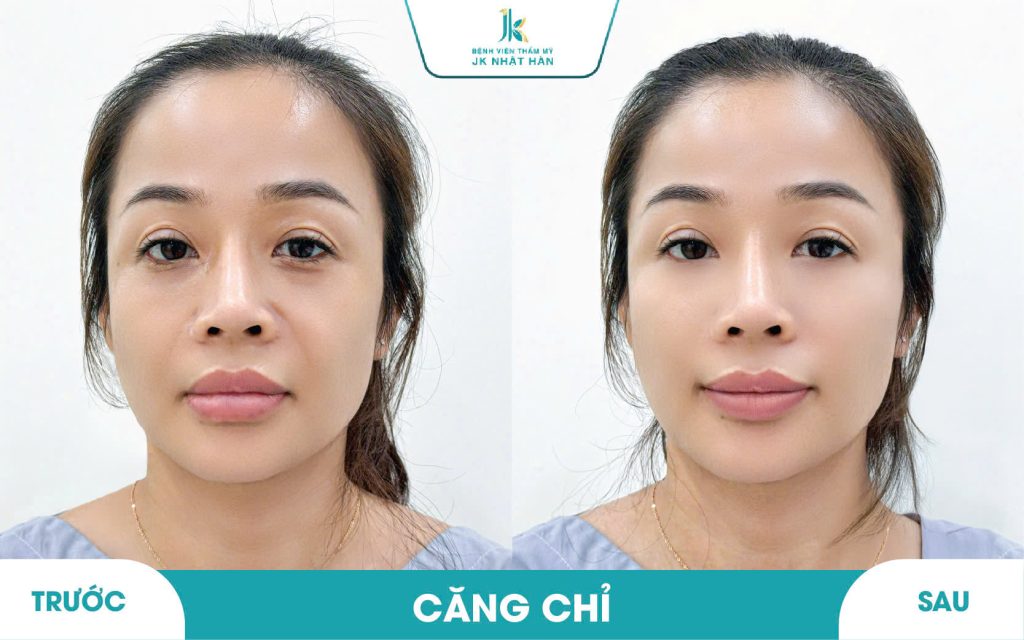 ảnh thực tế khách hàng thẩm mỹ không phẫu thuật 4
