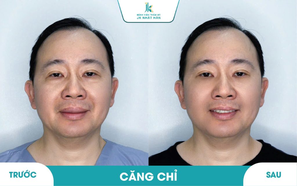 ảnh thực tế khách hàng thẩm mỹ không phẫu thuật 5