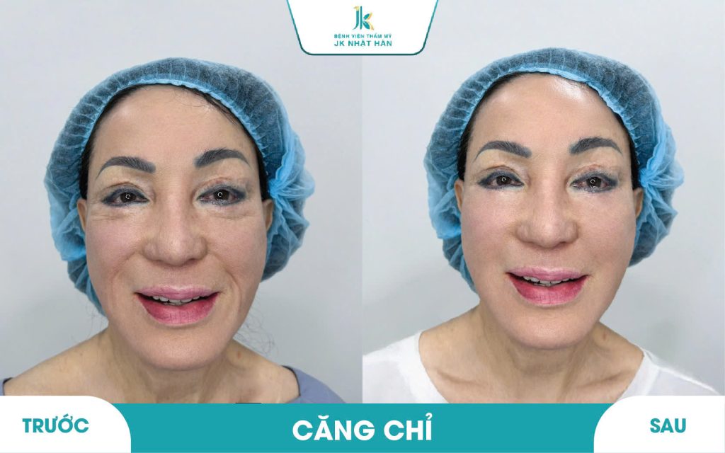 ảnh thực tế khách hàng thẩm mỹ không phẫu thuật 8