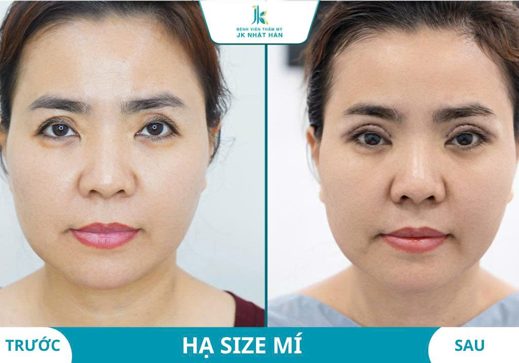 ảnh thực tế khách hàng thẩm mỹ mắt 1