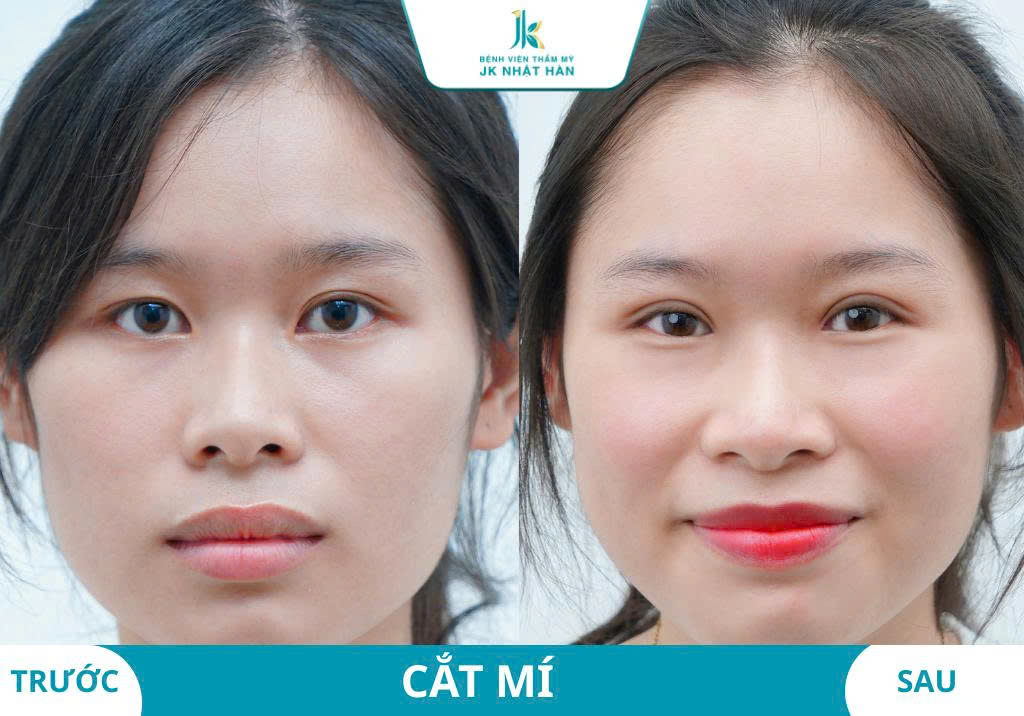 Ảnh khách hàng thẩm mỹ mũi tại JK Nhật Hàn 9