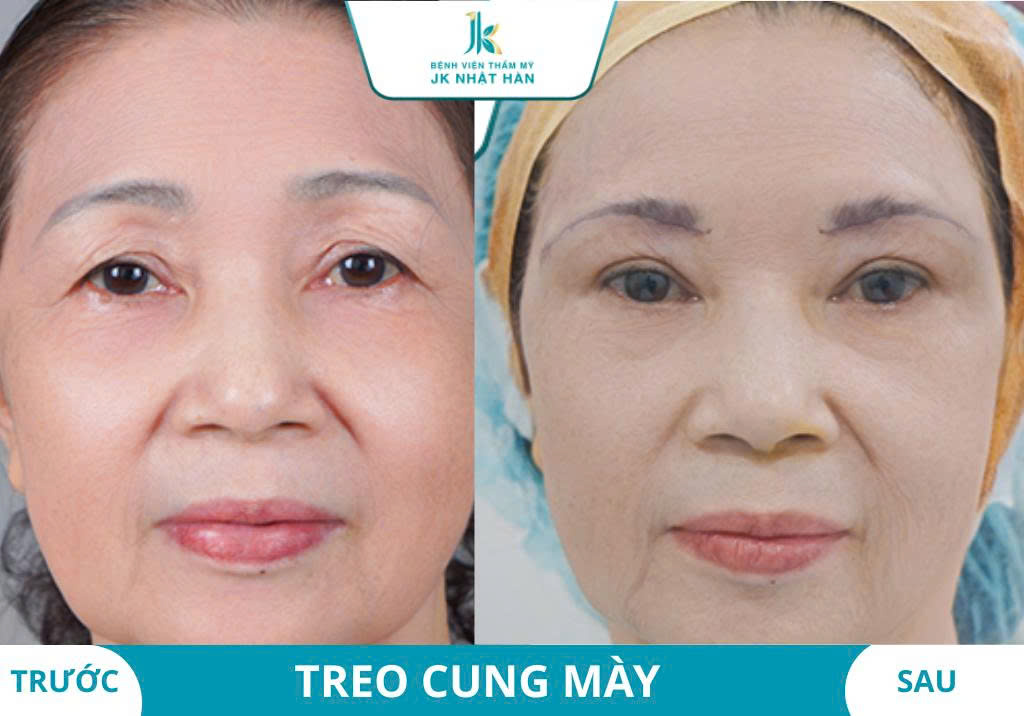 Ảnh khách hàng thẩm mỹ mũi tại JK Nhật Hàn 10