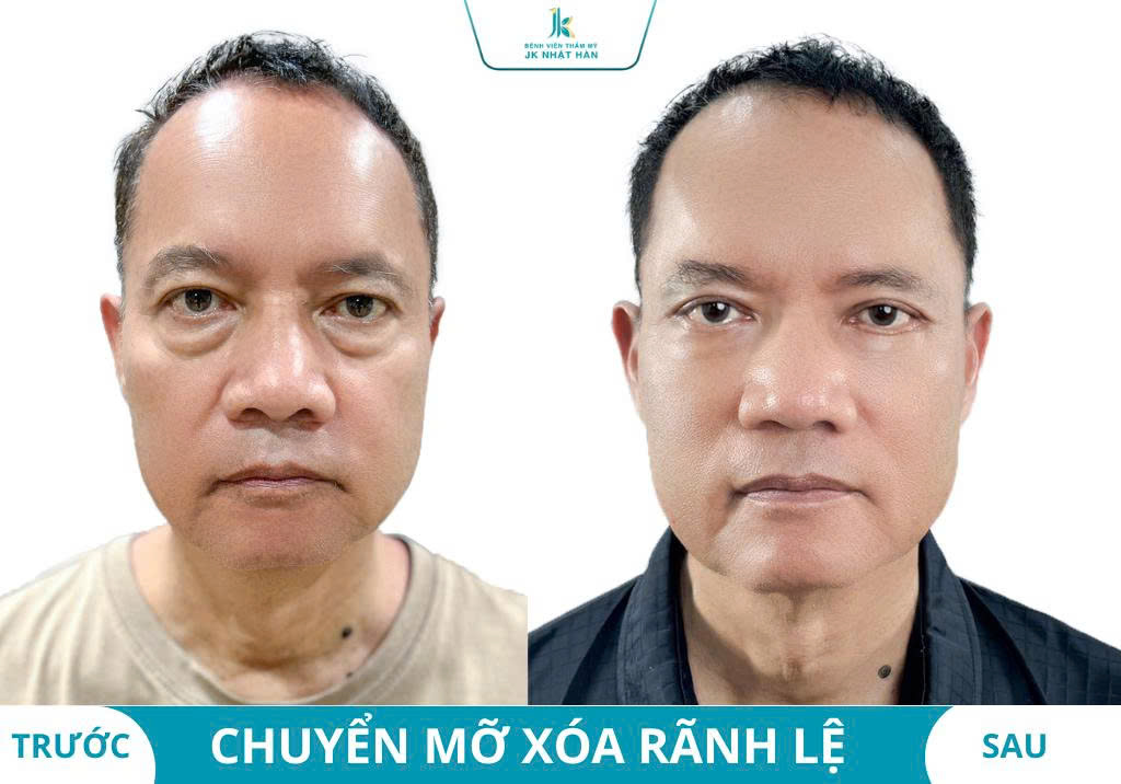 Ảnh khách hàng thẩm mỹ mũi tại JK Nhật Hàn 11