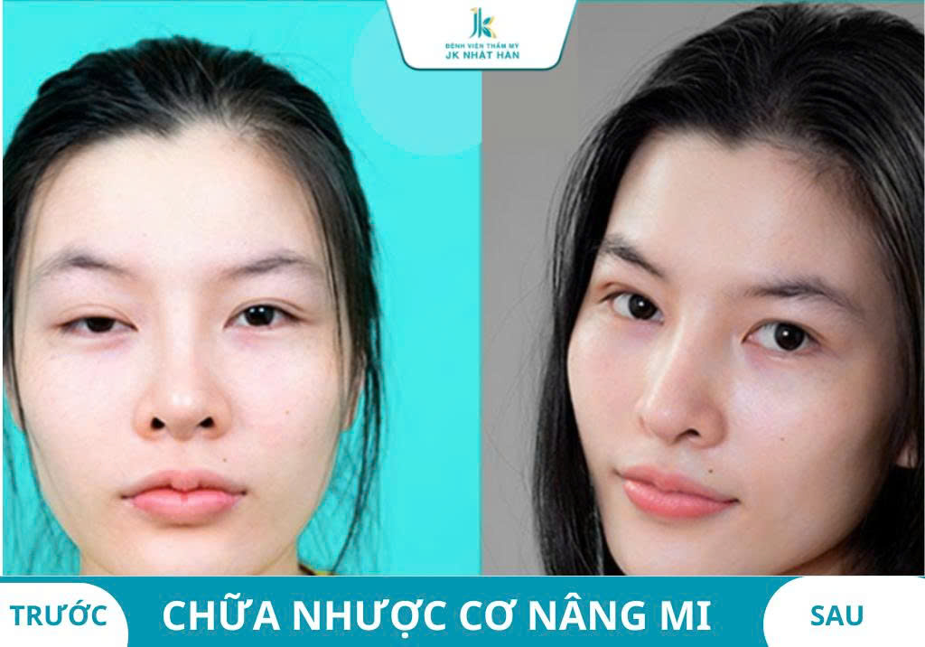 Ảnh khách hàng thẩm mỹ mũi tại JK Nhật Hàn 12