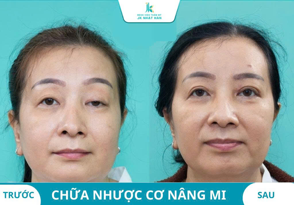 Ảnh khách hàng thẩm mỹ mũi tại JK Nhật Hàn 13