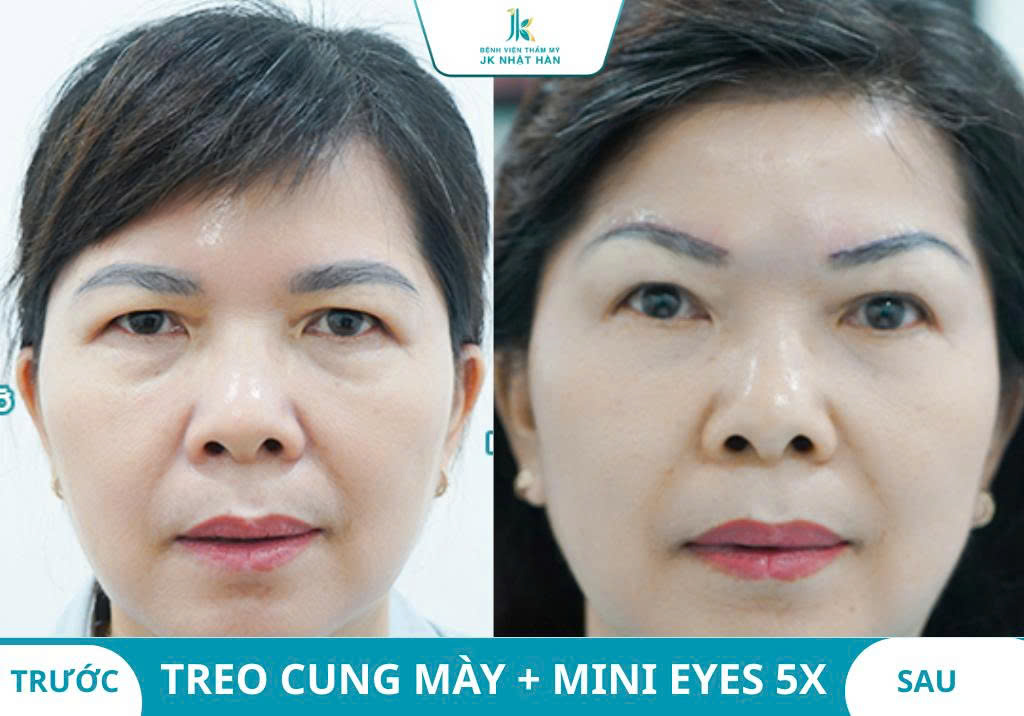 Ảnh khách hàng thẩm mỹ mũi tại JK Nhật Hàn 14