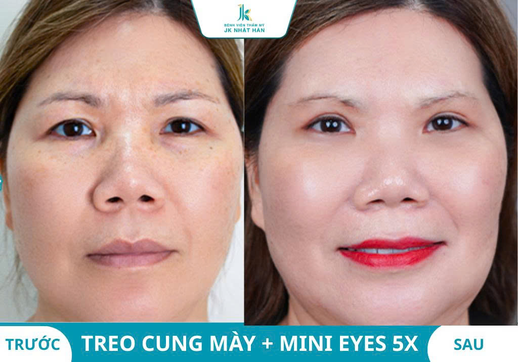 Ảnh khách hàng thẩm mỹ mũi tại JK Nhật Hàn 15