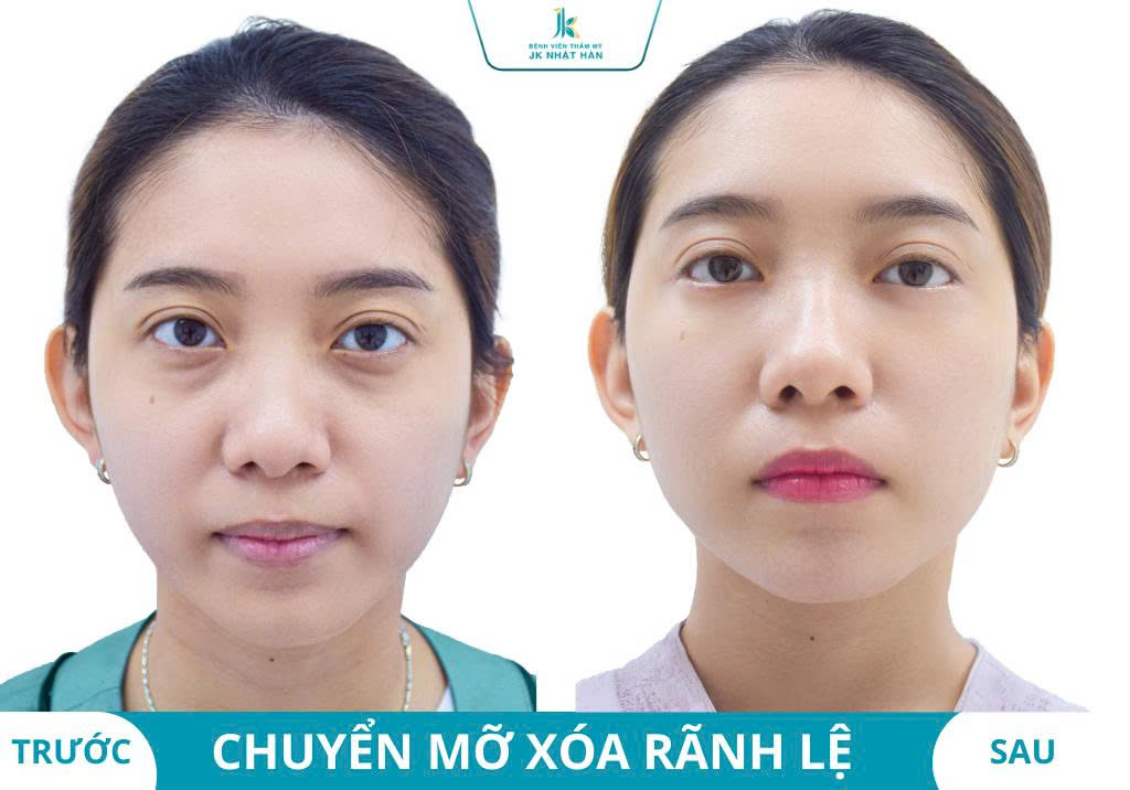 Ảnh khách hàng thẩm mỹ mũi tại JK Nhật Hàn 16