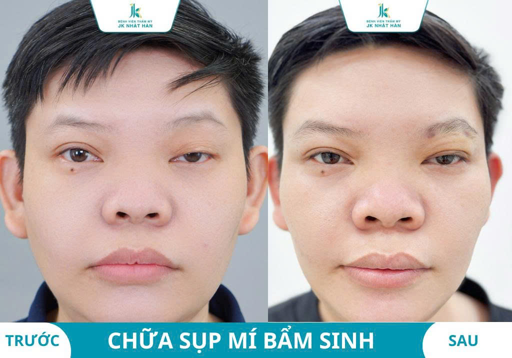 Ảnh khách hàng thẩm mỹ mũi tại JK Nhật Hàn 17