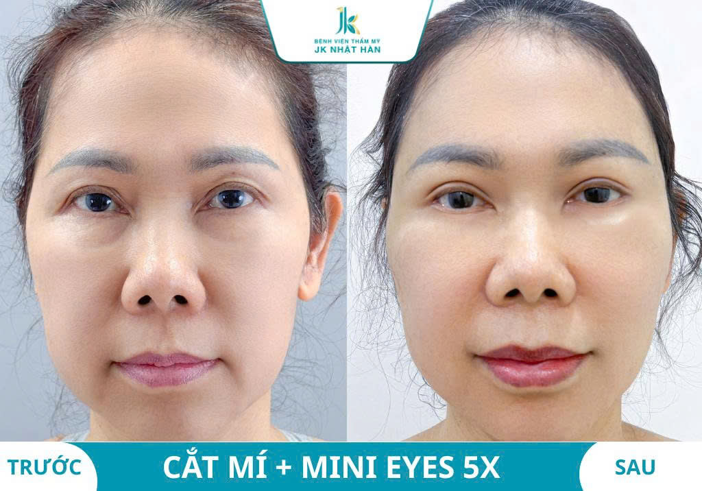 Ảnh khách hàng thẩm mỹ mũi tại JK Nhật Hàn 18