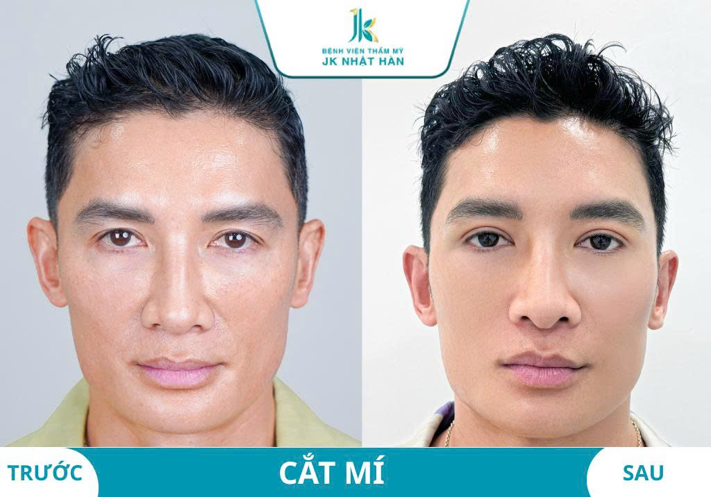ảnh thực tế khách hàng thẩm mỹ mắt 4