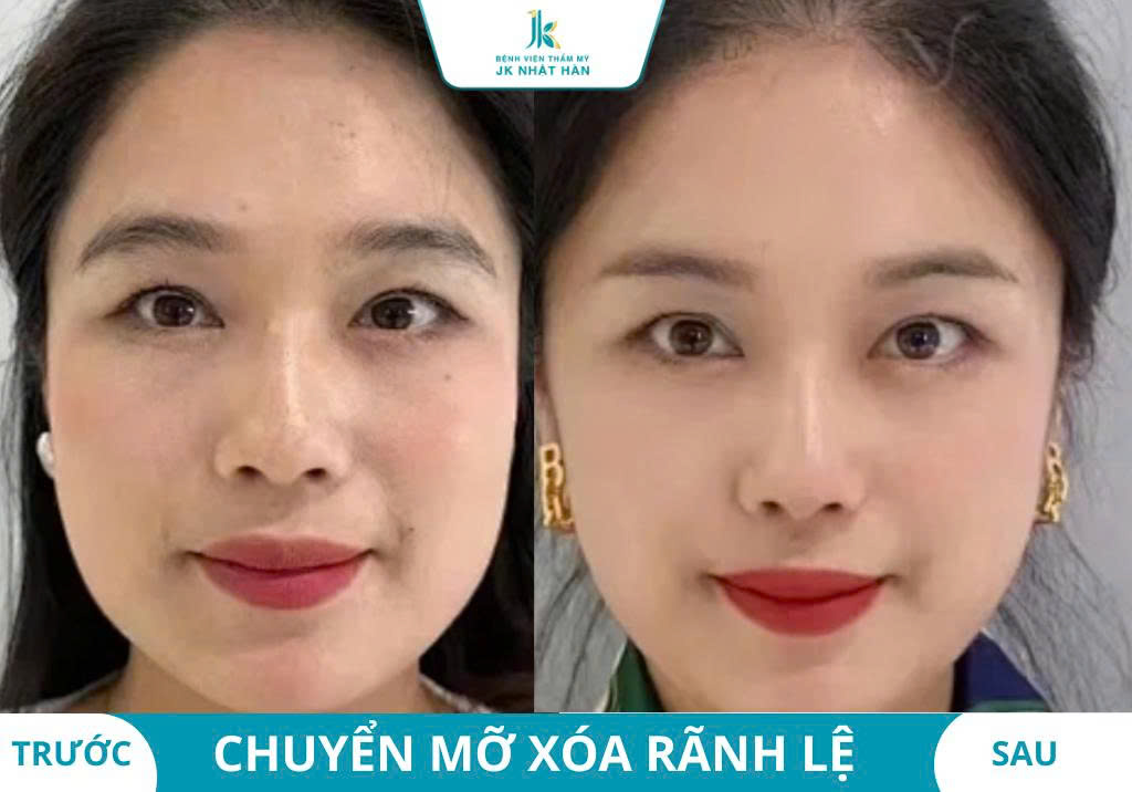 ảnh thực tế khách hàng thẩm mỹ mắt 5