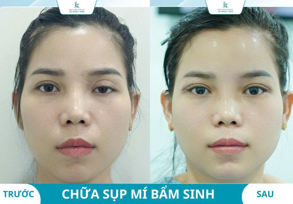 ảnh thực tế khách hàng thẩm mỹ mắt 6