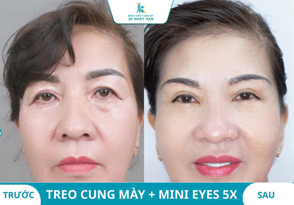 ảnh thực tế khách hàng thẩm mỹ mắt 8