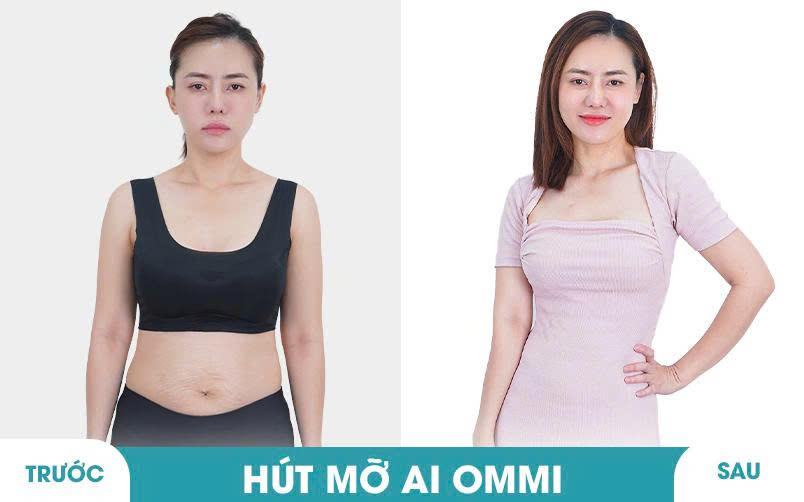 Ảnh khách hàng thẩm mỹ mũi tại JK Nhật Hàn 10