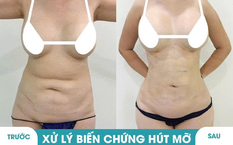 Ảnh khách hàng thẩm mỹ mũi tại JK Nhật Hàn 11